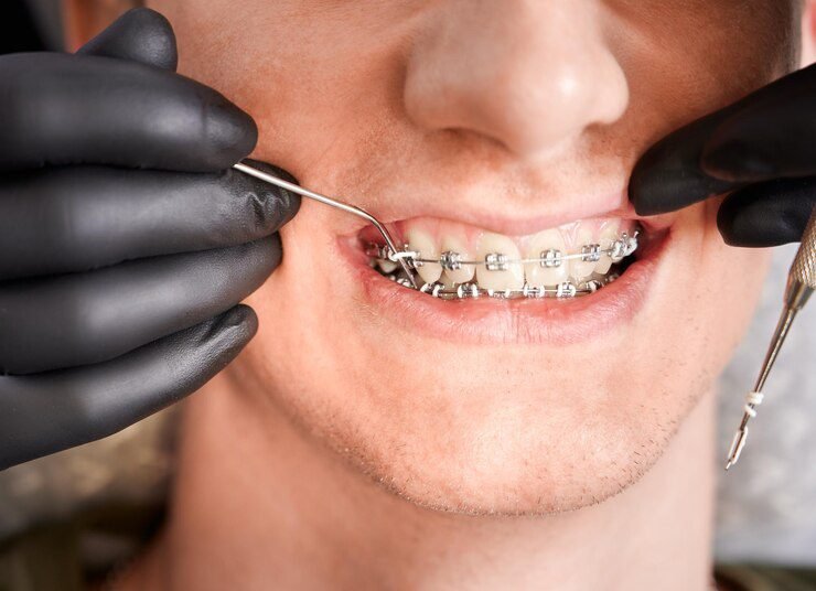 - Orthodontic Treatment: Examining the connection between braces and white spots.