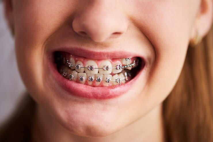 Determining the Need for Braces