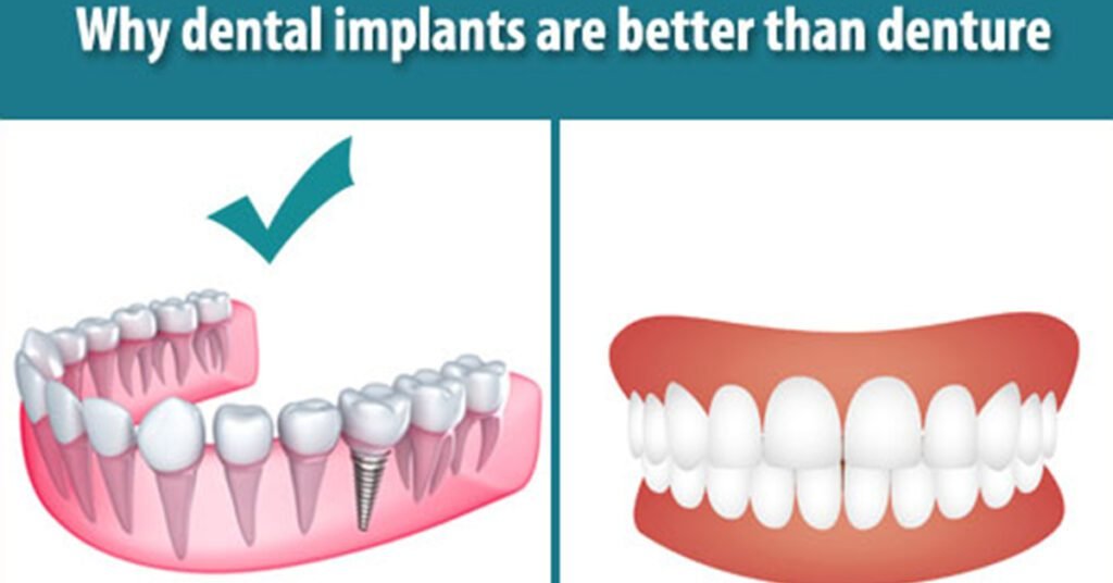 Dental Implants vs. Traditional Dentures: Understanding the Differences