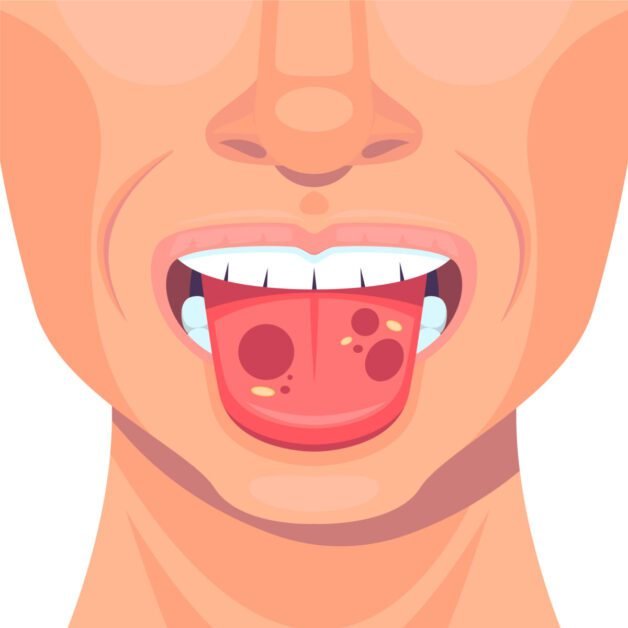 Symptoms and Signs of Canker Sores