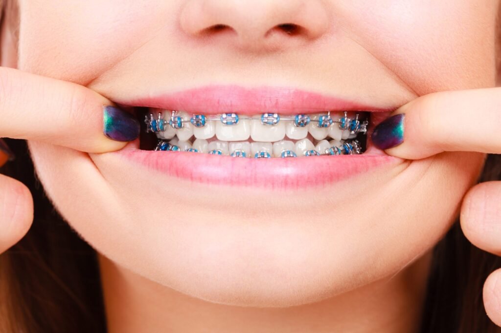 Braces: More Than Just a Cosmetic Solution: How They Can Improve Your Health and Well-Being