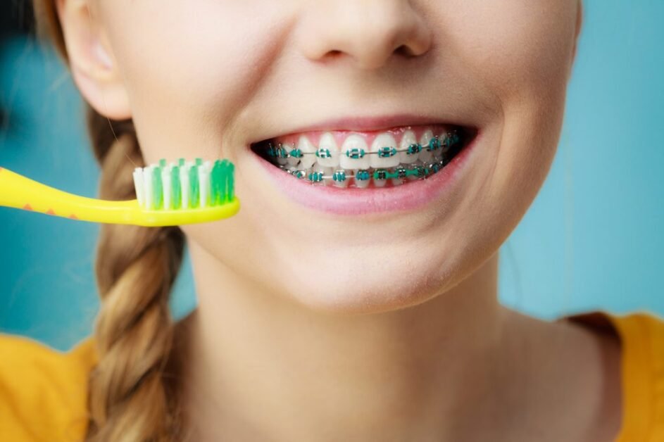 Braces and the Prevention of Dental Decay and Gum Disease