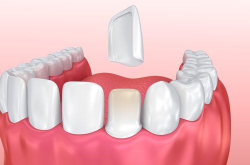 Dental Veneers to Fix a Cracked Tooth