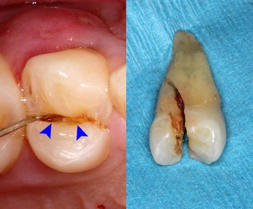 Diagnosing a Cracked Tooth