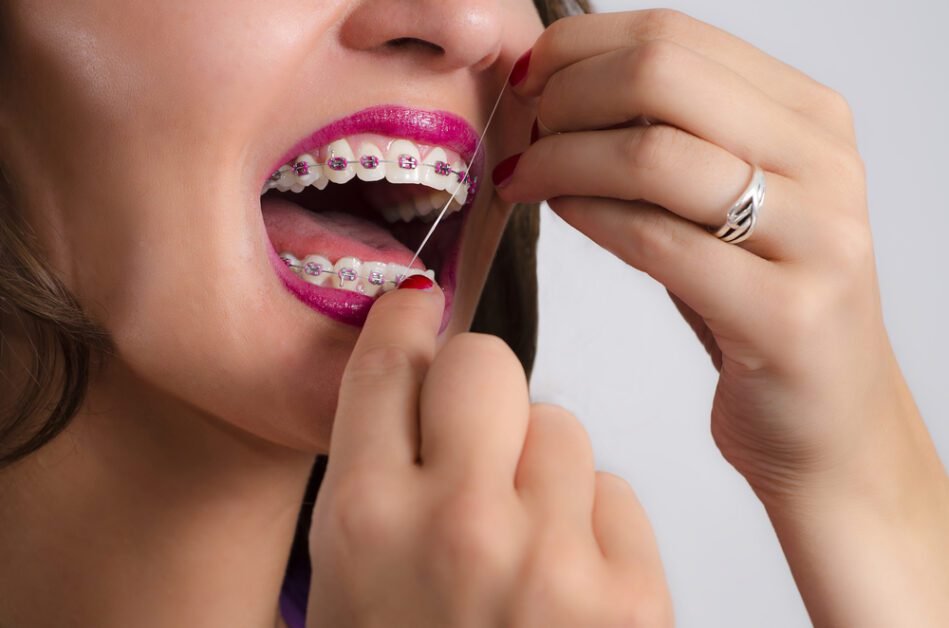 Flossing for Those with Braces or Dental Implants
