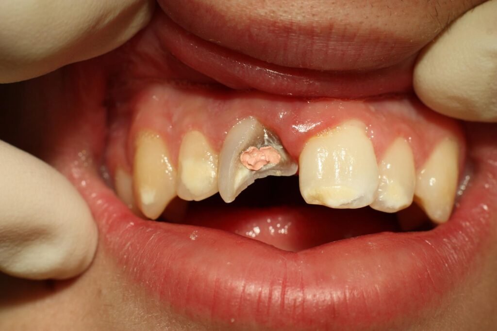 Handling a Chipped Tooth
