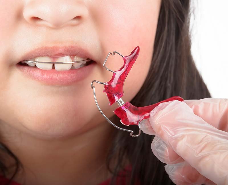Removable Retainers: An Overview