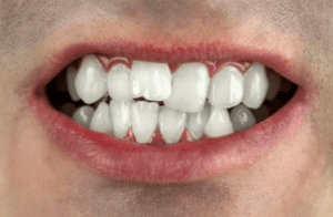 The Impact of Misaligned Teeth on Oral Health