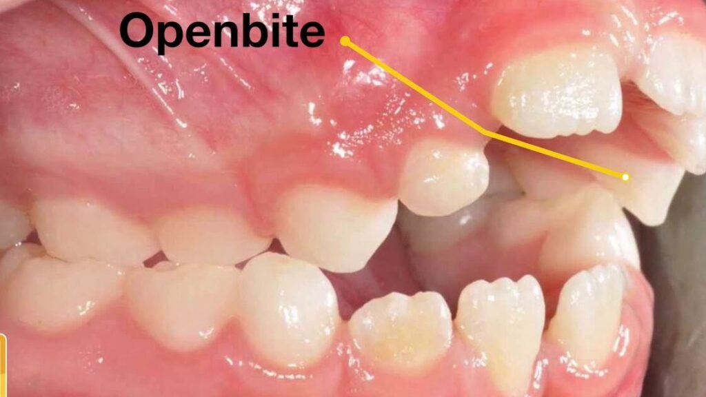 Potential Long-Term Effects on Teeth Alignment