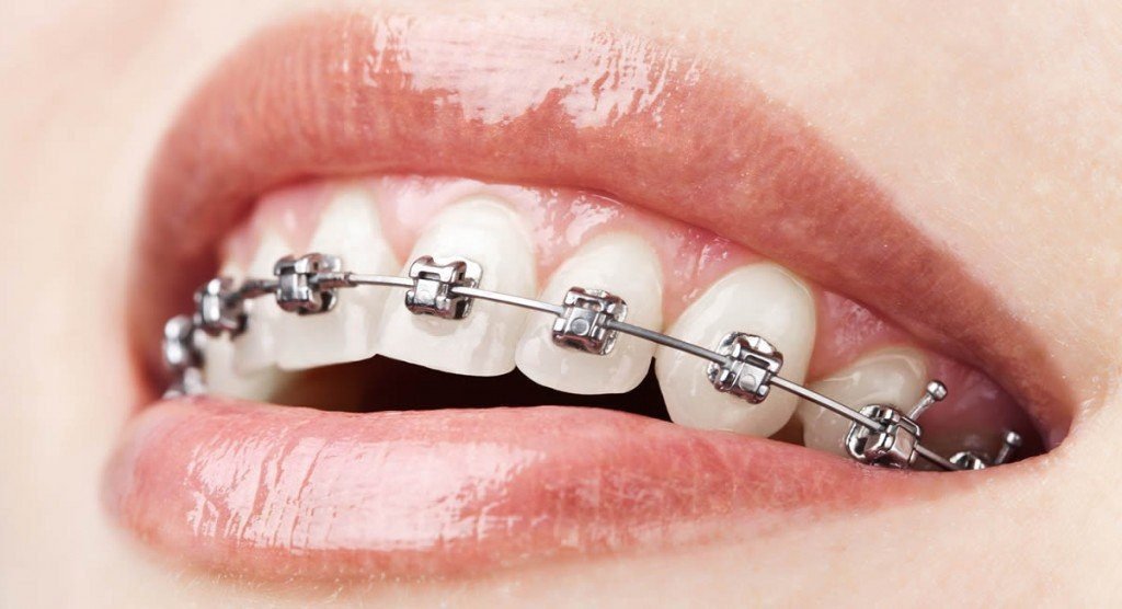 Understanding the Role of Braces in Dental Health