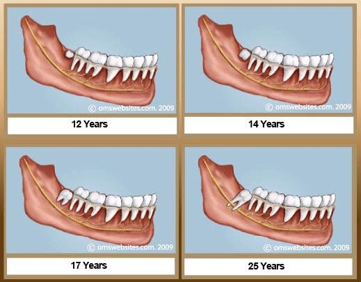 When do wisdom teeth usually start to grow?