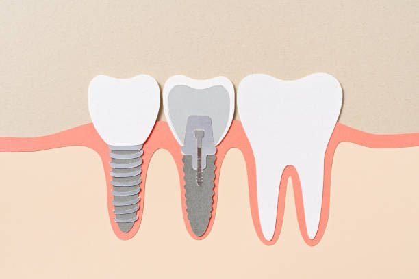 Dental Implants: Exploring Your Options for Tooth Replacement