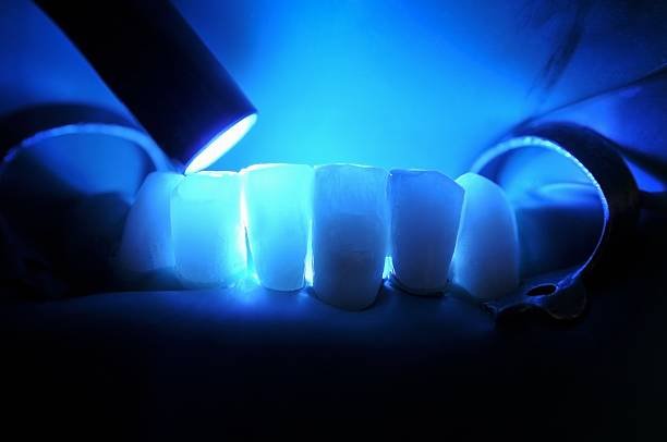 Less Risk of Allergic Reactions: Composite fillings are made of biocompatible materials, minimizing the risk of allergic reactions commonly associated with metal fillings