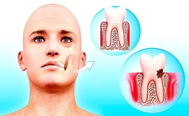 Common Symptoms of Gum Problems