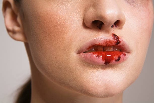 Tongue or Lip Injury: First aid measures for injuries to the tongue or lip caused by accidental biting or trauma.