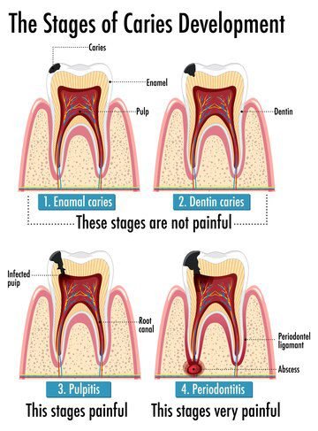Impact on tooth enamel erosion