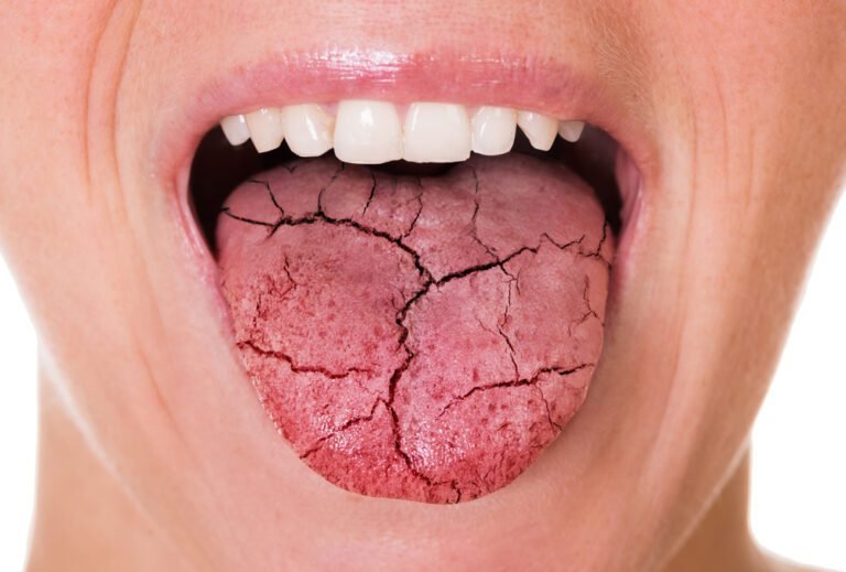 How to Beat Dry Mouth: Causes, Symptoms, and Treatment Options