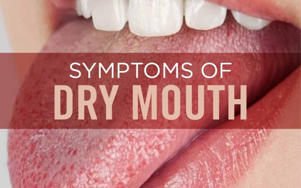 Symptoms of Dry Mouth