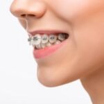 Braces: More Than Just a Cosmetic Solution