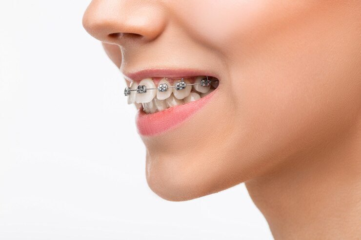 Braces: More Than Just a Cosmetic Solution