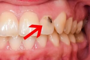 Causes of Front Teeth Cavities