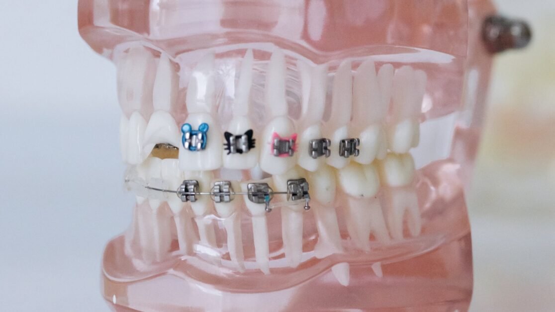 How Braces Correct Dental Misalignments