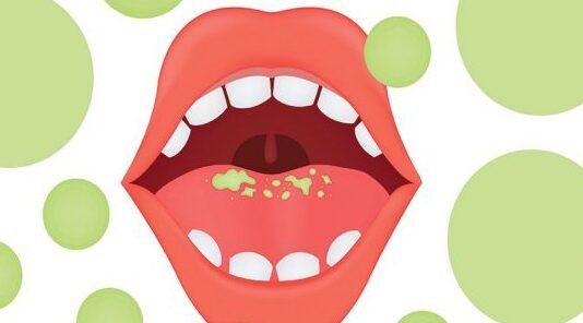 Understanding the causes of bad breath