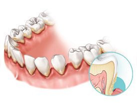 Addressing a Severely Loose Tooth