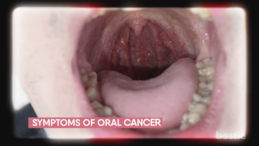 Risk Factors for Oral Cancer