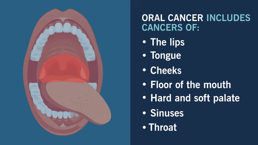 Common Locations for Oral Cancer