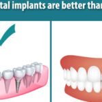 Dental Implants vs. Traditional DTypes of Dental Implantsentures: Understanding the Differences