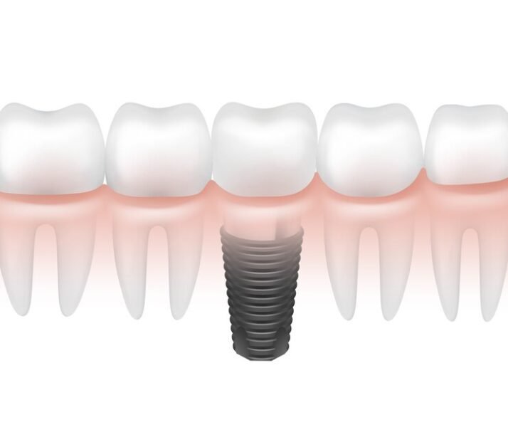 - Restoring Damaged Teeth with Dental Crowns: Regain Strength and Functionality