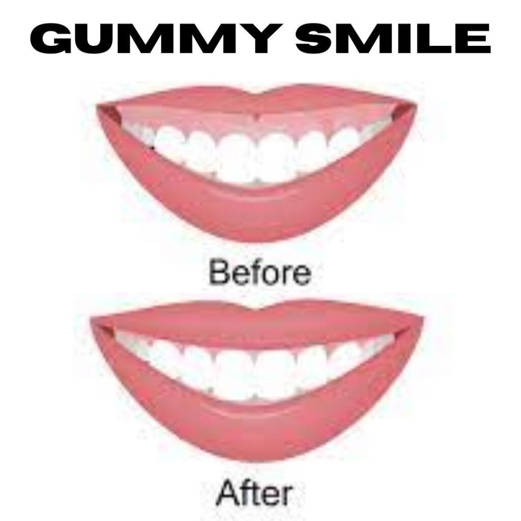 Determining the Cause of a Gummy Smile