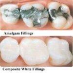 Amalgam vs. Composite Fillings: Which Is Right for You?