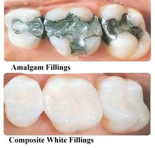 Amalgam vs. Composite Fillings: Which Is Right for You?