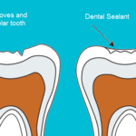 An Affordable Way to Protect Your Smile: Dental Sealants for Children and Adults