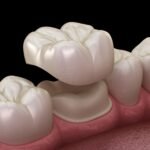 Cap It With a Crown: Restoring Damaged Teeth with Dental Crowns