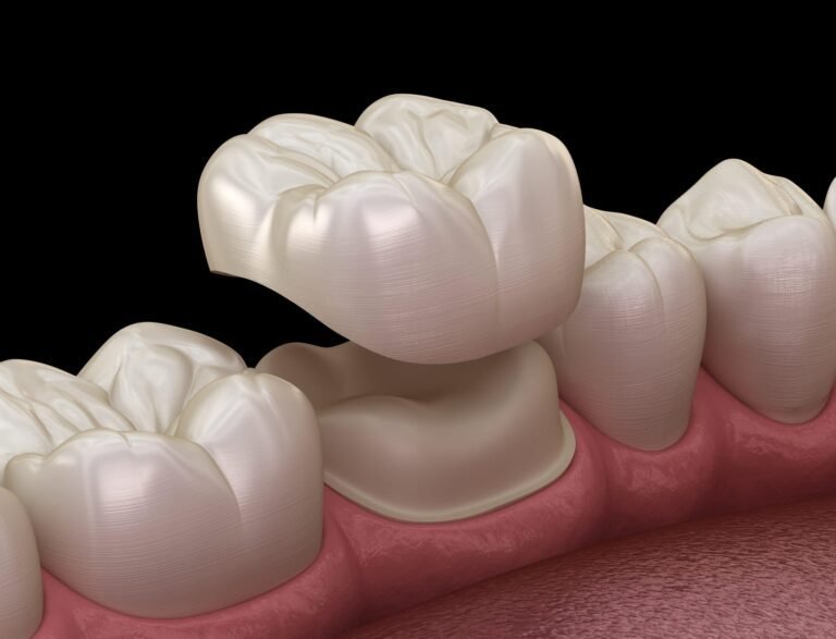 Cap It With a Crown: Restoring Damaged Teeth with Dental Crowns