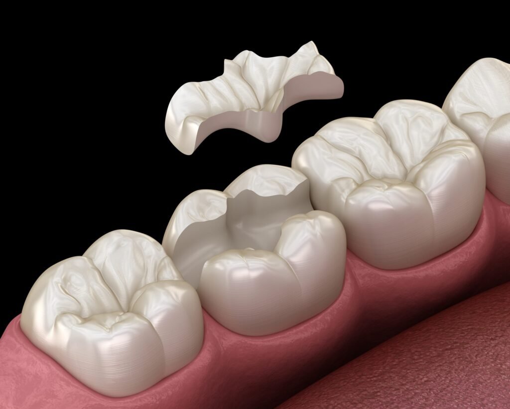 Are Dental Inlays and Onlays a Suitable Option for Everyone?