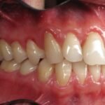Understanding the Role of Back Teeth in Dental Health