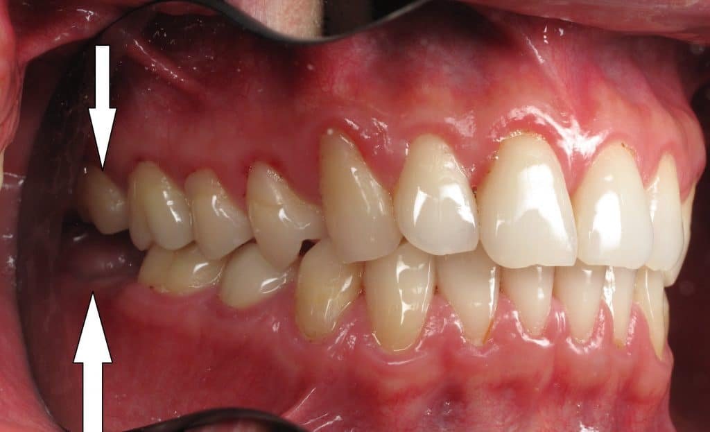 Understanding the Role of Back Teeth in Dental Health