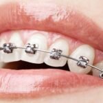 6 Things to Do Before Getting Braces for a Smooth and Successful Treatment