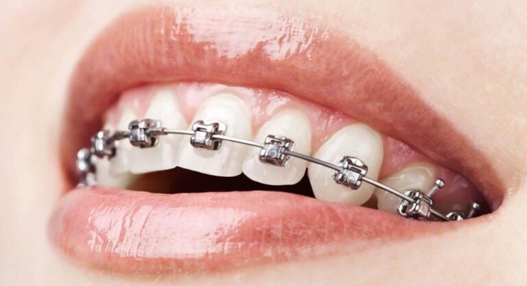 6 Things to Do Before Getting Braces for a Smooth and Successful Treatment