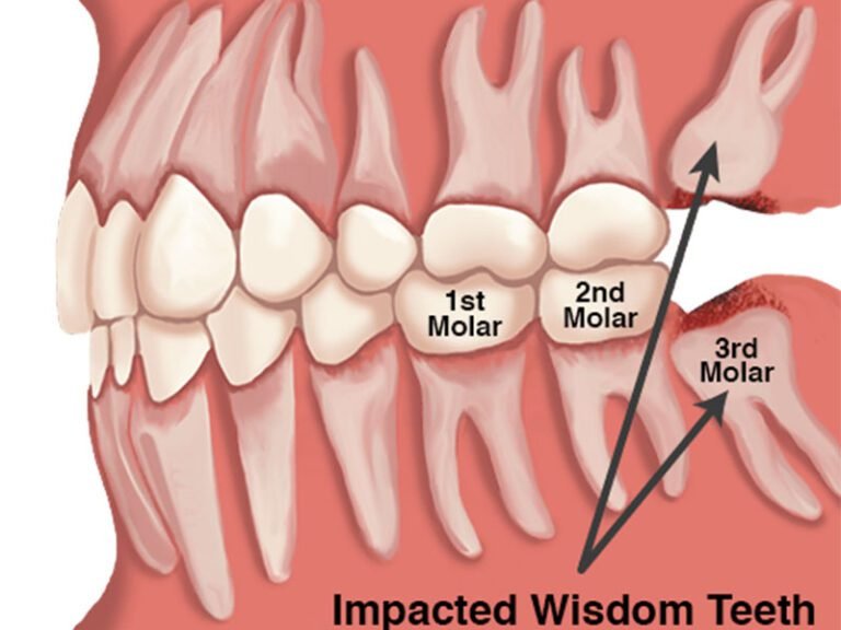 Wisdom Teeth: The Latecomers with Uncertain Purpose