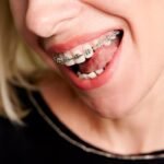 When Is the Right Time? Determining the Best Age for Braces