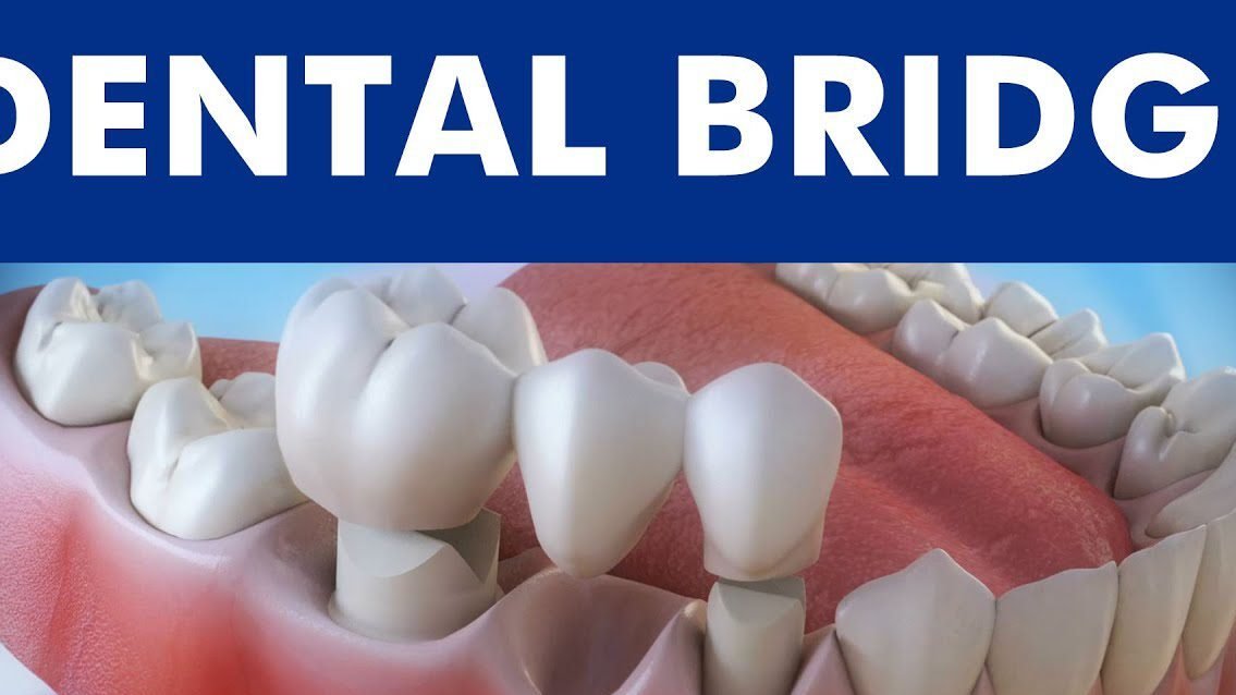 - Exploring the Advantages of Dental Bridges: Filling the Gap