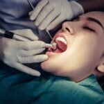 Cavity Treatment Without Drilling? The Promise of Icon Resin Infiltration