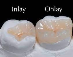 Differences between Dental Inlays and Onlays