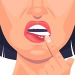 Canker Sores: Small Size, Big Pain