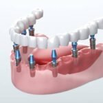 Are Dental Implants Right for You? Benefits, Risks, and Alternatives